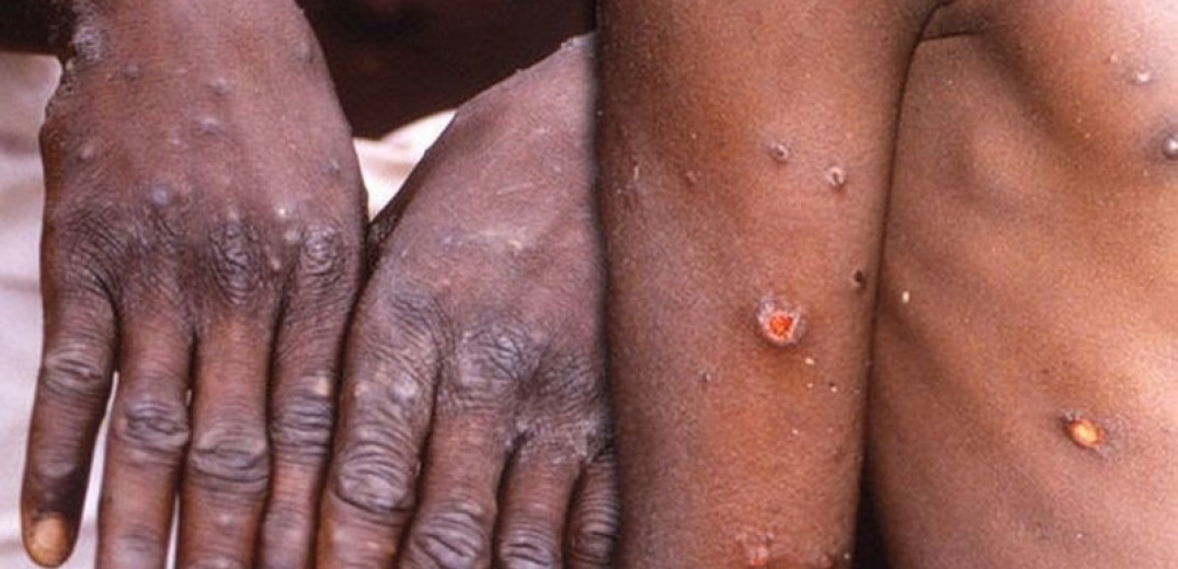 Ευλογιά των πιθήκων: Υπαρκτός ο κίνδυνος να καταστεί ενδημική η νόσος