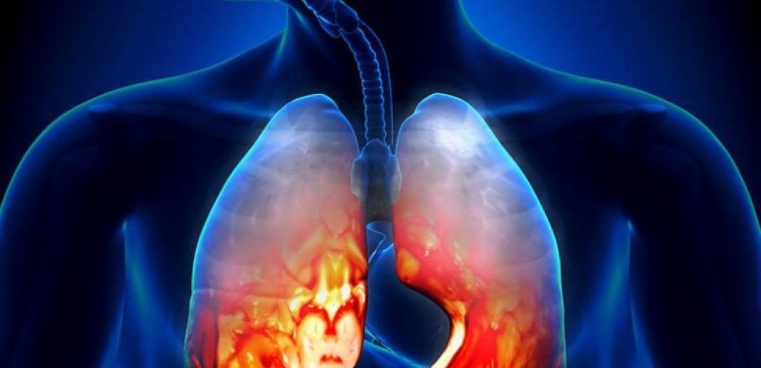 Έλληνες ερευνητές λύνουν τον γρίφο των σοβαρών λοιμώξεων του αναπνευστικού
