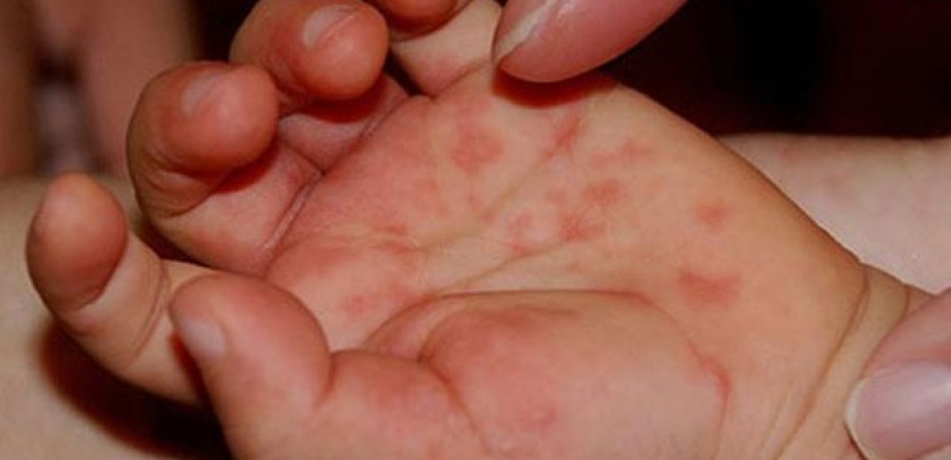 ΠΟΥ: Αυξήθηκαν κατά 300% τα κρούσματα ιλαράς σε όλον τον κόσμο