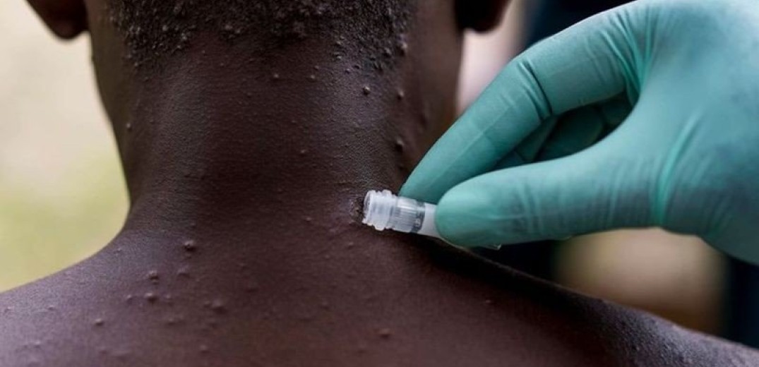 Εμβολιαστική καμπάνια και για την ευλογιά των πιθήκων στην Ευρώπη